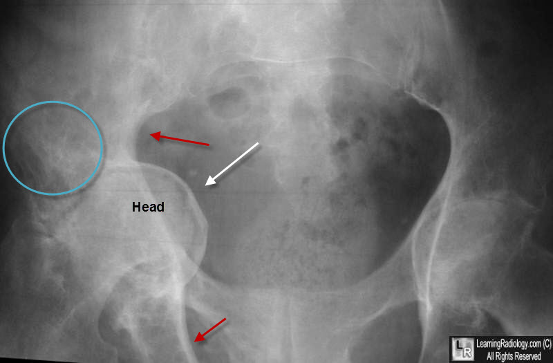 Acetabular Protrusio.